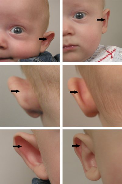 Sorribes Online Ear Method - Correction of protuding ears